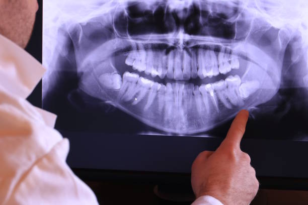 Best Emergency Wisdom Teeth Removal in Vicksburg, MS
